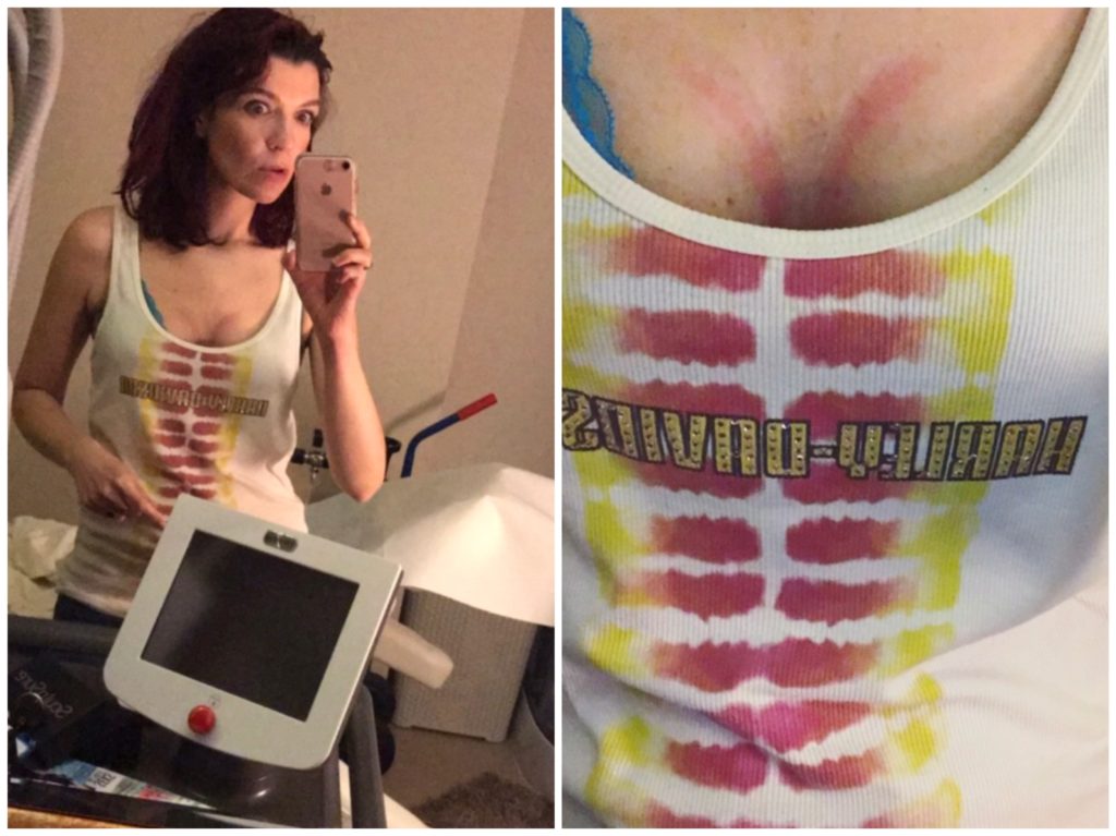 Cyc w górę, czyli o zabiegu, który naprawdę podnosi biust