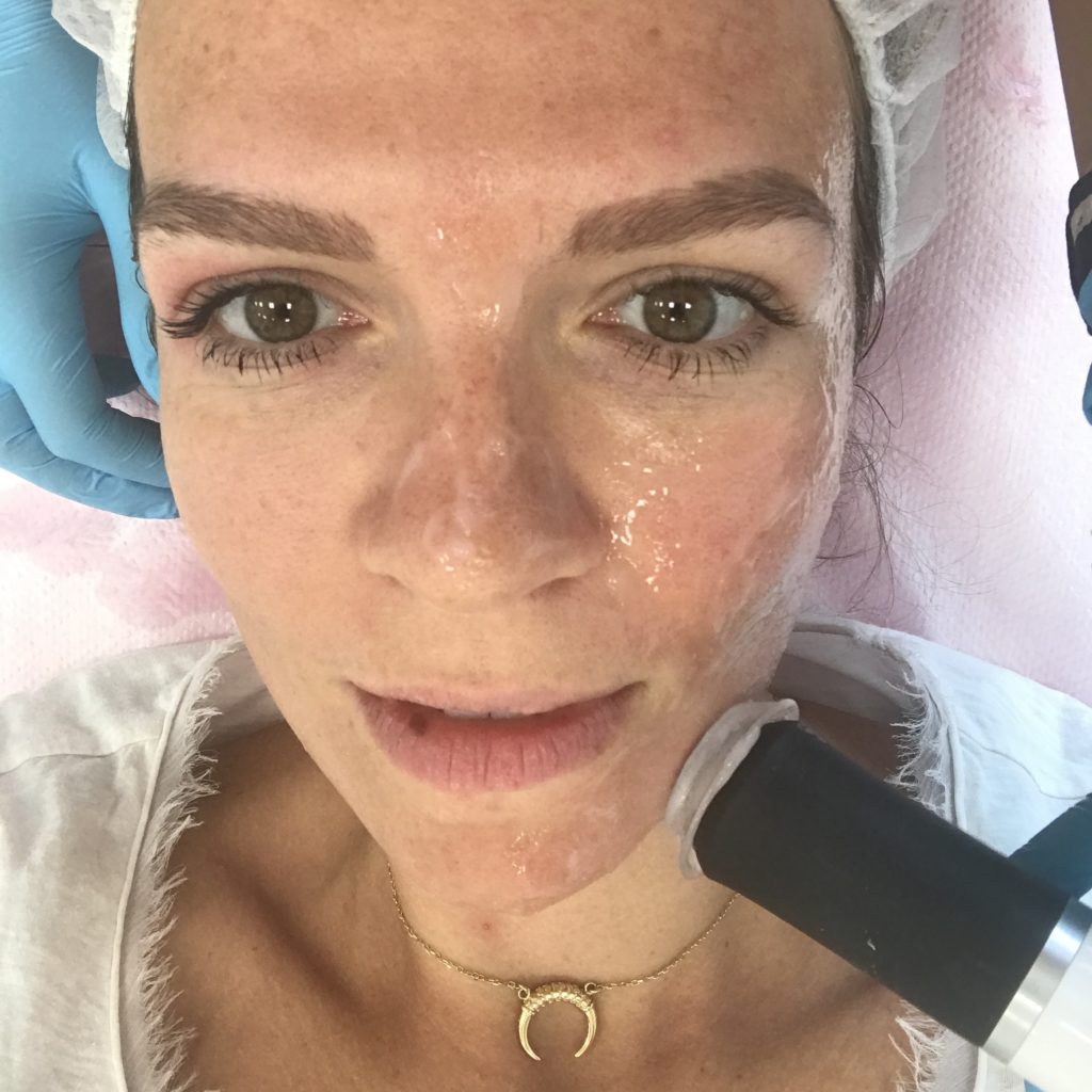 Geneo. Genialny zabieg zwężający rozszerzone pory